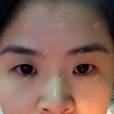 双眼皮