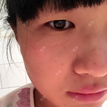 双眼皮