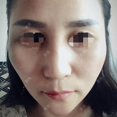隆鼻