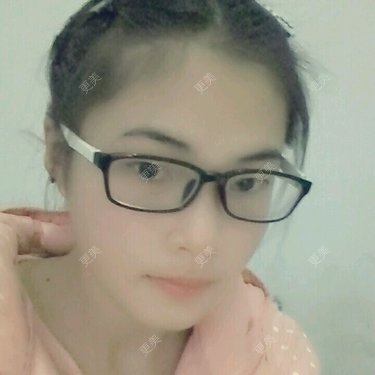 双眼皮