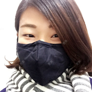 双眼皮