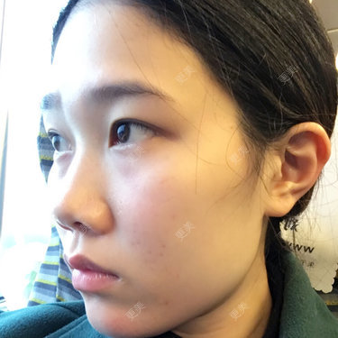 隆鼻
