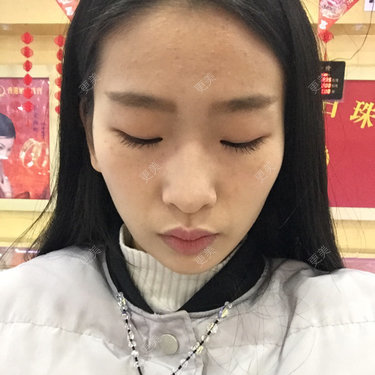 太阳穴