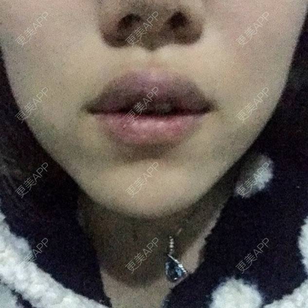 更美 - 更美用户qSB0r1Jjtp的玻尿酸唇部经验 | 玻尿酸唇部 | 丰唇珠 | 注射美容