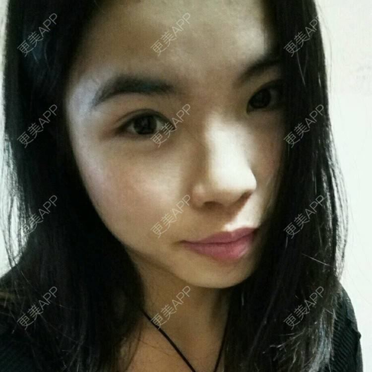 更美 - 更美用户85009132的外切去眼袋经验 | 外切去眼袋 | 东莞 | 双眼皮