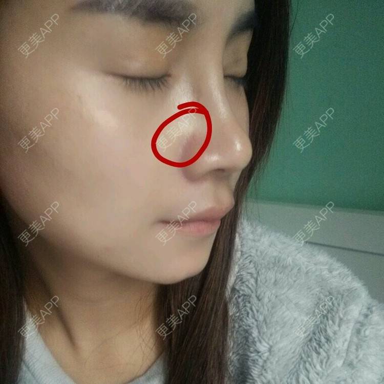 更美 - 嫣 然。的经验 | 鼻基底