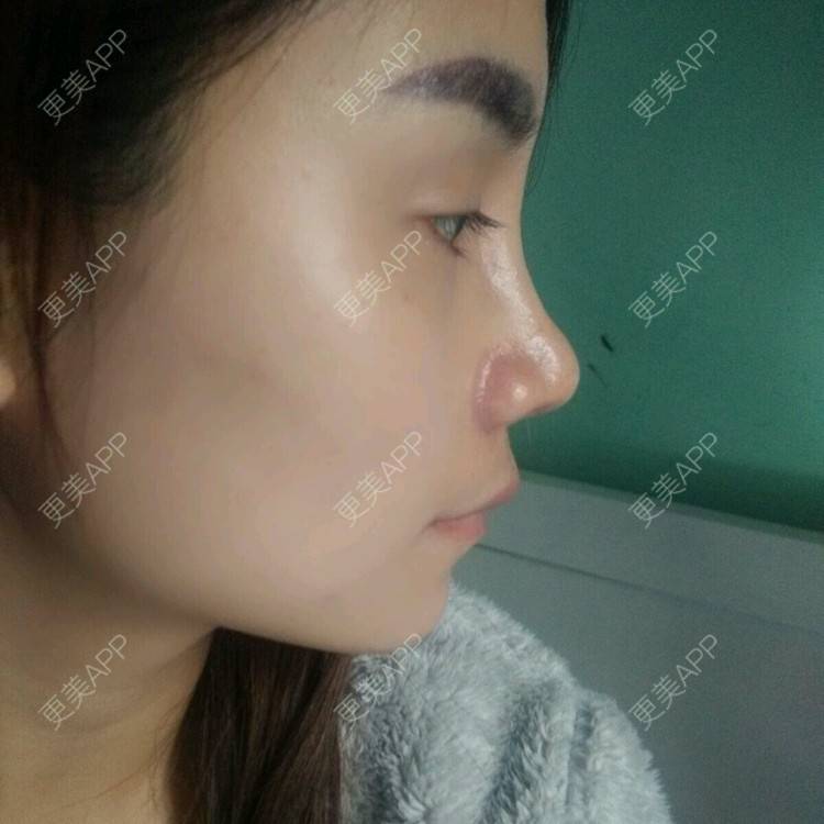 更美 - 嫣 然。的经验 | 鼻基底