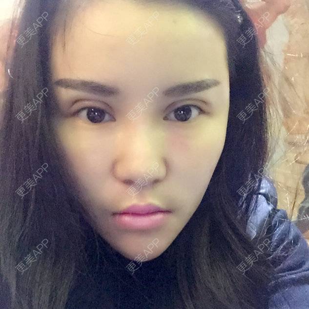 更美 - 뻔뻔한 거짓말的外切去眼袋经验 | 自体脂肪丰太阳穴 | 杭州 | 自体脂肪填充泪沟 | 自体脂肪垫下巴 | 外切去眼袋