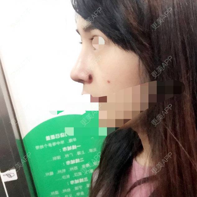 更美 - 小小Rui的经验 | 美购日记 | 缩鼻头鼻翼 | 鼻中骨垫鼻小柱 | 鼻部多项 | 长沙