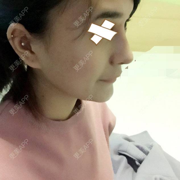 更美 - 小小Rui的经验 | 美购日记 | 缩鼻头鼻翼 | 鼻中骨垫鼻小柱 | 鼻部多项 | 长沙