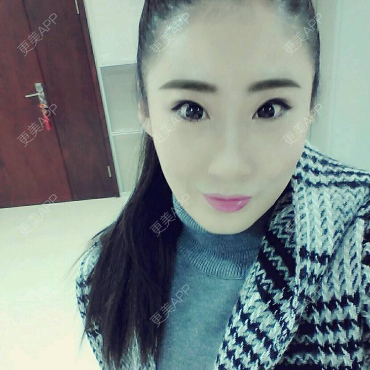 更美 - 壮壮的红蓝光清痘经验 | 威海 | 祛疤痕痘印 | 红蓝光清痘 | 鼻部多项 | 双眼皮