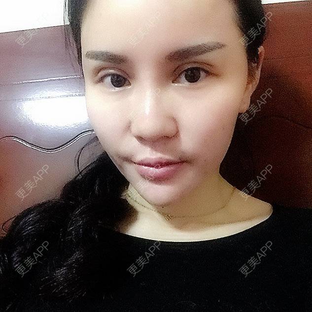 更美 - 뻔뻔한 거짓말的外切去眼袋经验 | 自体脂肪丰太阳穴 | 杭州 | 自体脂肪填充泪沟 | 自体脂肪垫下巴 | 外切去眼袋