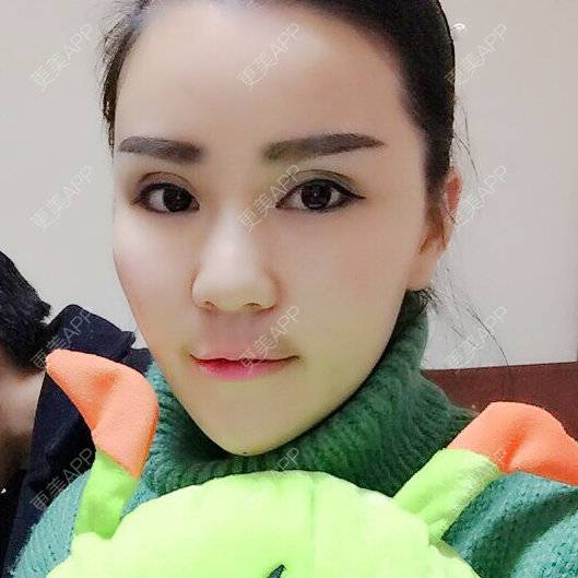 更美 - 뻔뻔한 거짓말的外切去眼袋经验 | 自体脂肪丰太阳穴 | 杭州 | 自体脂肪填充泪沟 | 自体脂肪垫下巴 | 外切去眼袋