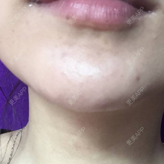 更美 - 更美用户95002155的经验 | 轮廓修复 | 沈阳