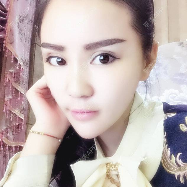 更美 - 뻔뻔한 거짓말的外切去眼袋经验 | 自体脂肪丰太阳穴 | 杭州 | 自体脂肪填充泪沟 | 自体脂肪垫下巴 | 外切去眼袋