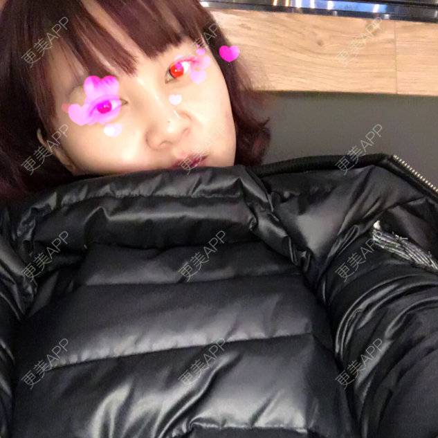 更美 - belle戴的玻尿酸太阳穴经验 | 美购日记 | 玻尿酸太阳穴 | 上海