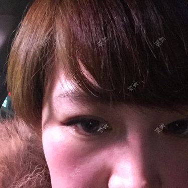 眼睑
