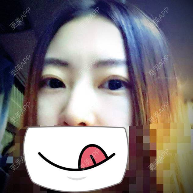更美 - 清泉石上游的外切去眼袋经验 | 美购日记 | 术后求抱抱 | 你看我整哪 | 外切去眼袋 | 双眼皮微创 | 北京
