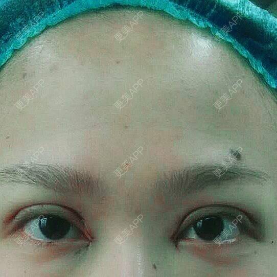 开内眼角效果图_更美用户iegaejdkmi开内眼角效果图_更美
