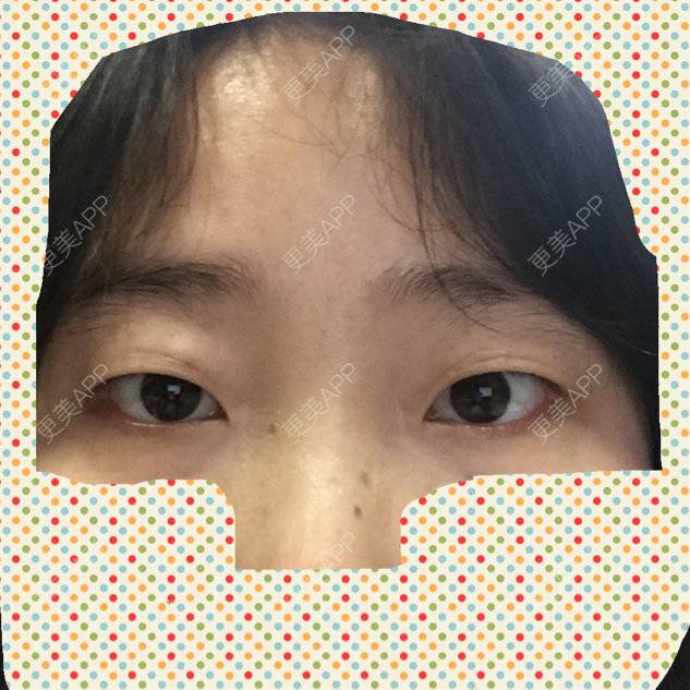 更美 - 柒柒想变公举的全切双眼皮经验 | 你看我整哪 | 眼部整形 | 全切双眼皮 | 新年心愿 | 绍兴