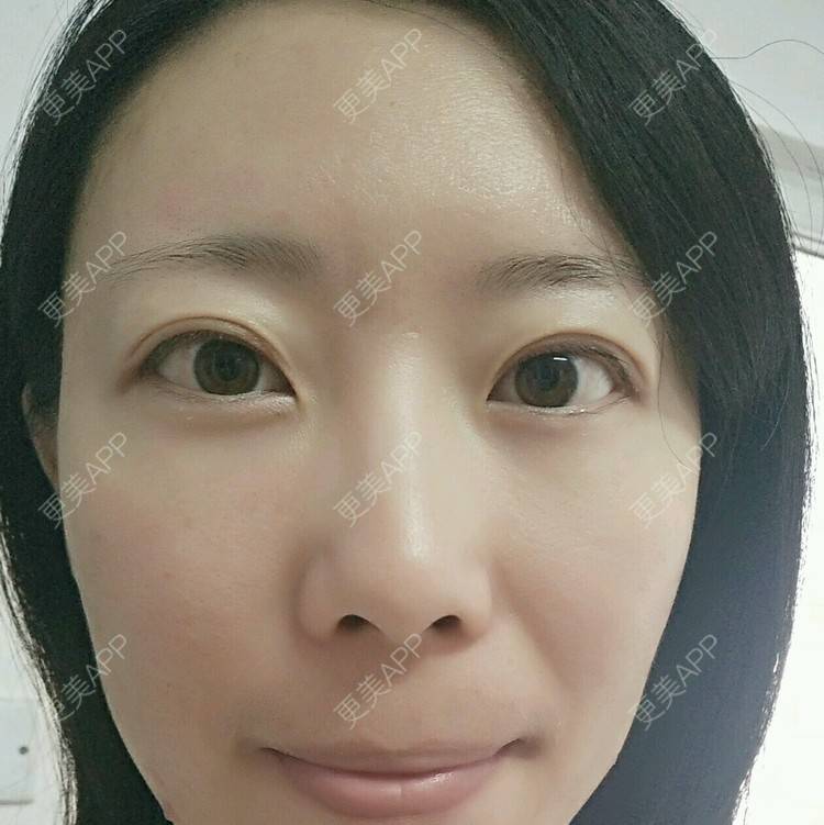 更美 - 清风起舞Winnie的准分子激光原位角膜磨镶术经验 | 准分子激光原位角膜磨镶术 | 美购日记 | 北京