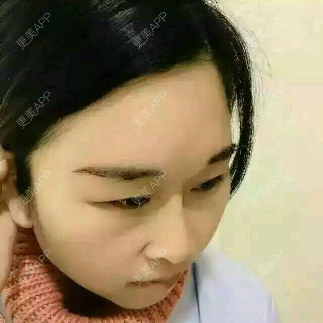 更美 - 你小色猪的经验 | 植发其他项目 | 眉毛种植
