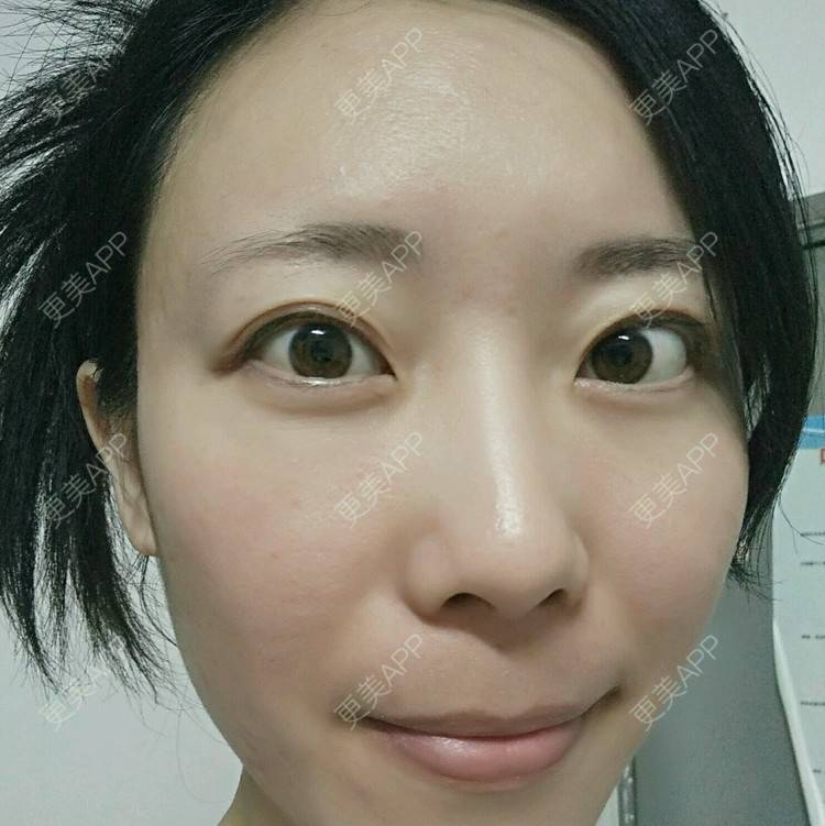 更美 - 清风起舞Winnie的准分子激光原位角膜磨镶术经验 | 准分子激光原位角膜磨镶术 | 美购日记 | 北京