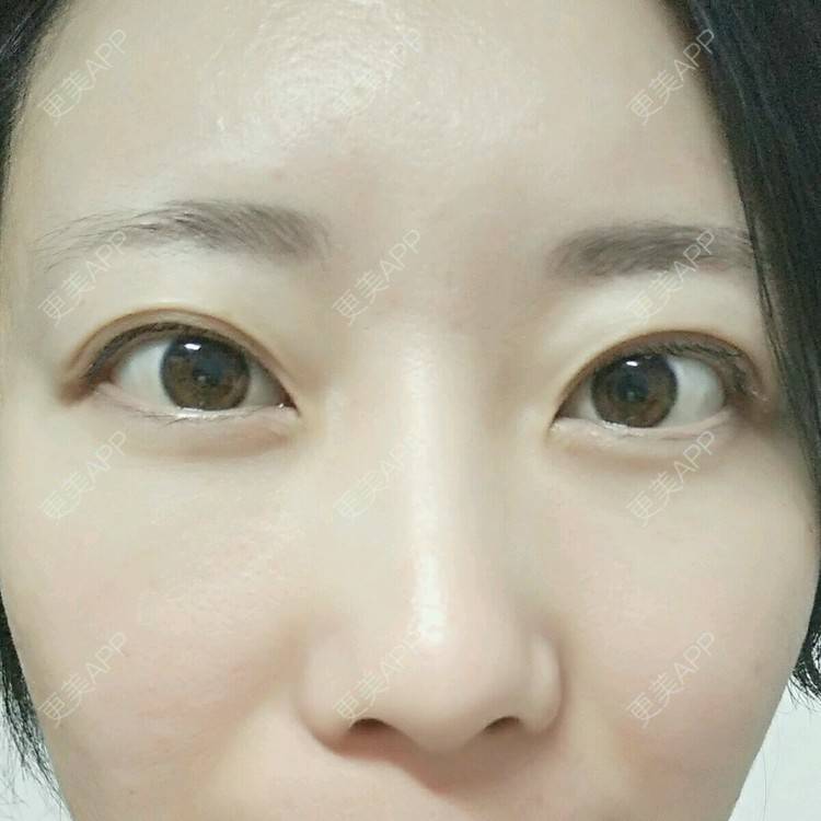 更美 - 清风起舞Winnie的准分子激光原位角膜磨镶术经验 | 准分子激光原位角膜磨镶术 | 美购日记 | 北京