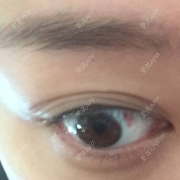 更美 - 转战新_氧，这太垃圾的准分子激光原位角膜磨镶术经验 | 准分子激光原位角膜磨镶术 | 美购日记 | 北京