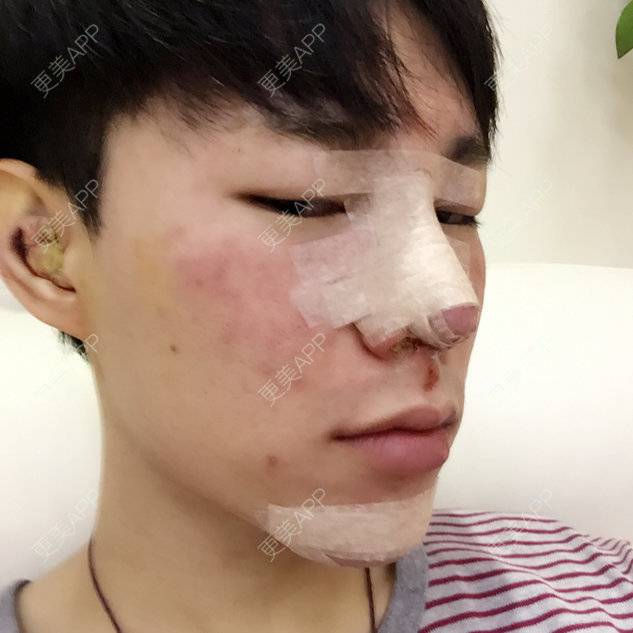 更美 - IMQTIP2的经验 | 假体垫下巴 | 假体隆鼻 | 鼻头塑形 | 广州