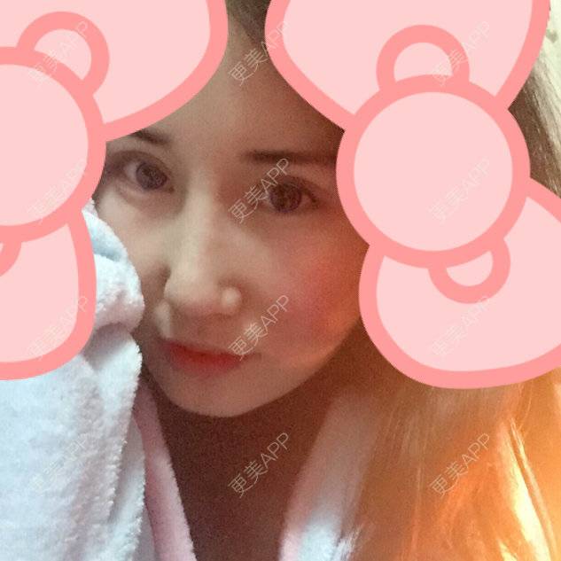 更美 - 美滴妞的全切双眼皮经验 | 眼部其他项目 | 全切双眼皮 | 开外眼角 | 美购日记 | 上眼睑去脂 | 眼皮下垂矫正 | 武汉