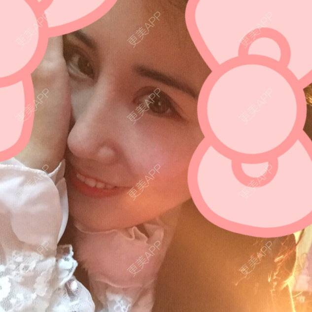 更美 - 美滴妞的全切双眼皮经验 | 眼部其他项目 | 全切双眼皮 | 开外眼角 | 美购日记 | 上眼睑去脂 | 眼皮下垂矫正 | 武汉