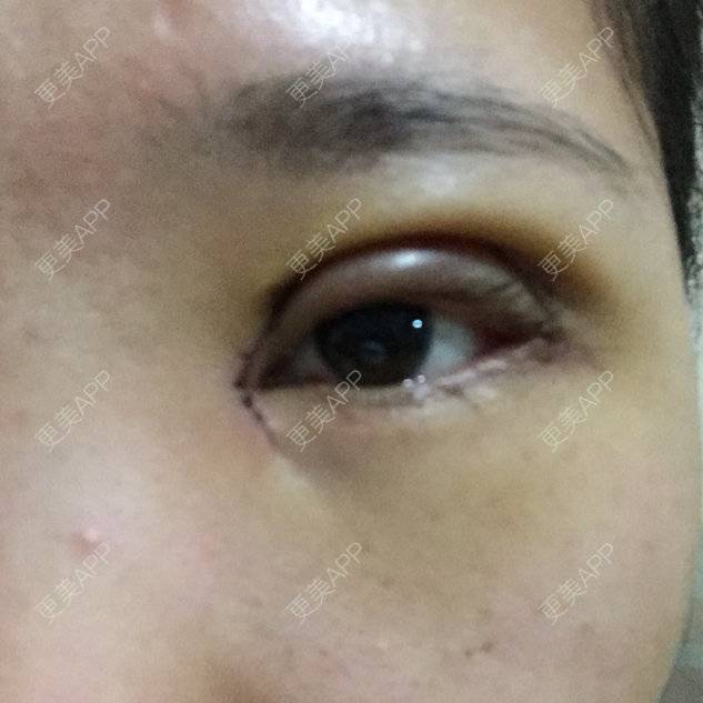 更美 - 伊伊  💕的双眼皮经验 | 双眼皮 | 开内外眼角 | 全切双眼皮 | 上睑下垂矫正