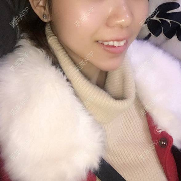 更美 - 更美用户85157678的玻尿酸太阳穴经验 | 注射美容 | 玻尿酸太阳穴 | 美购日记 | 玻尿酸 | 深圳