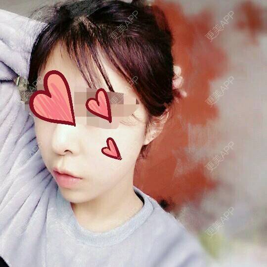 更美 - 爱爸爸妈妈的佳玲的玻尿酸下巴经验 | 玻尿酸下巴 | 阿拉善