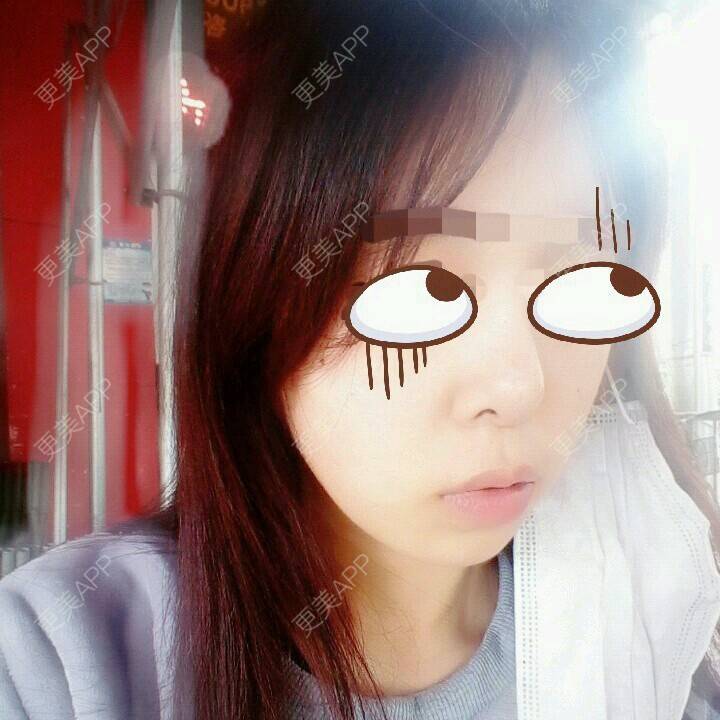更美 - 爱爸爸妈妈的佳玲的玻尿酸下巴经验 | 注射美容 | 晒对比照 | 玻尿酸下巴 | 阿拉善 | 玻尿酸