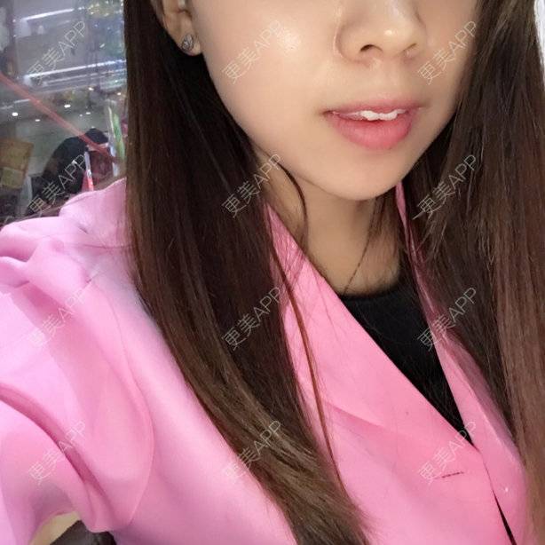 更美 - 更美用户85157678的玻尿酸太阳穴经验 | 注射美容 | 玻尿酸太阳穴 | 美购日记 | 玻尿酸 | 深圳