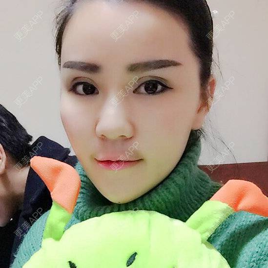 更美 - 뻔뻔한 거짓말的外切去眼袋经验 | 自体脂肪丰太阳穴 | 杭州 | 自体脂肪填充泪沟 | 自体脂肪垫下巴 | 外切去眼袋