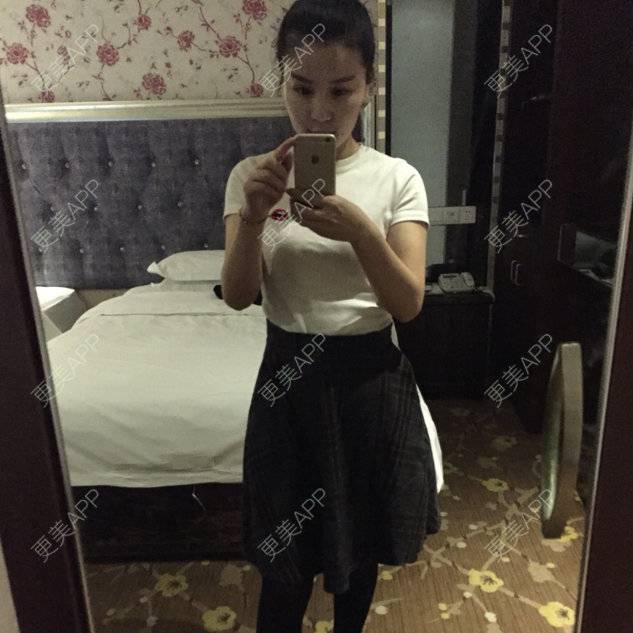 更美 - 뻔뻔한 거짓말的外切去眼袋经验 | 自体脂肪丰太阳穴 | 杭州 | 自体脂肪填充泪沟 | 自体脂肪垫下巴 | 外切去眼袋