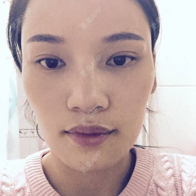 更美 - 更美用户z8AkyW42AQ的经验 | 自体脂肪丰面颊