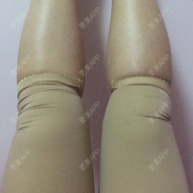 不要大肥腿的吸脂瘦大腿日记