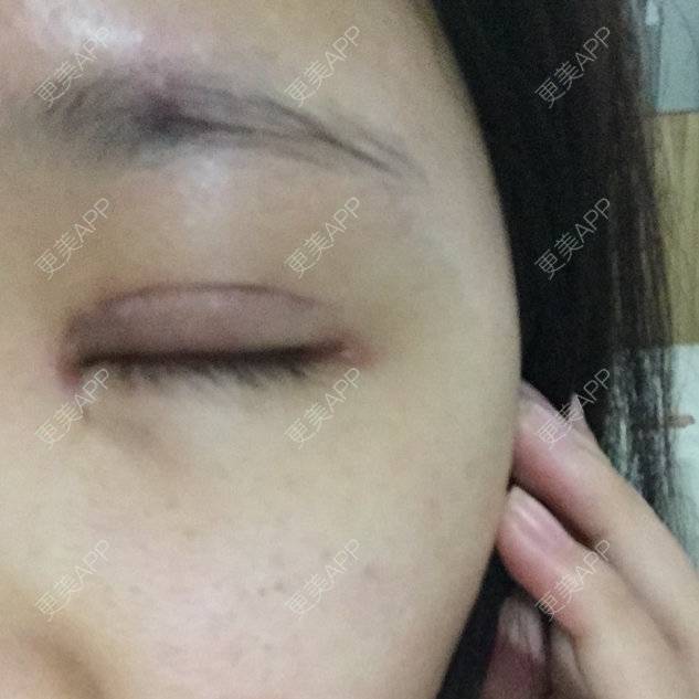 更美 - 伊伊  💕的双眼皮经验 | 双眼皮 | 开内外眼角 | 上睑下垂矫正 | 双眼皮手术