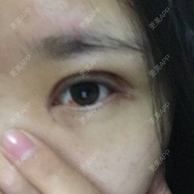 更美 - 伊伊  💕的双眼皮经验 | 双眼皮 | 开内外眼角 | 上睑下垂矫正 | 双眼皮手术