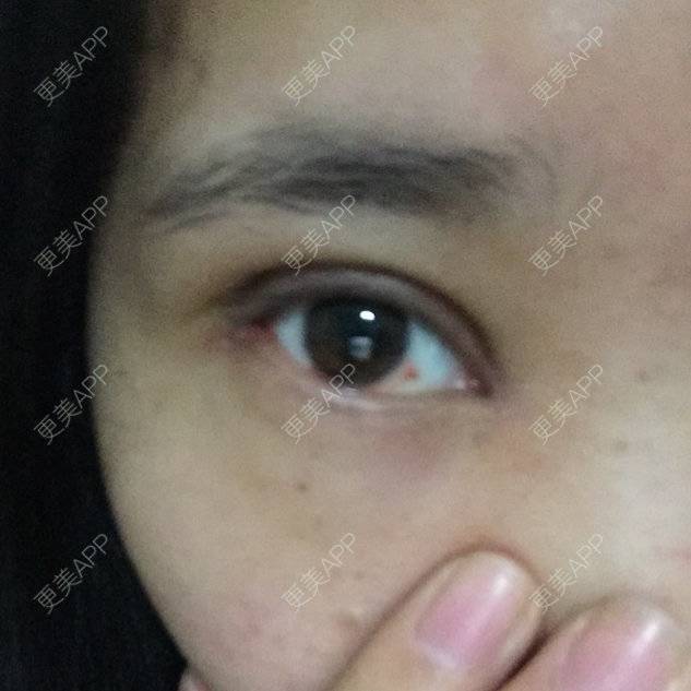 更美 - 伊伊  💕的双眼皮经验 | 双眼皮 | 开内外眼角 | 上睑下垂矫正 | 双眼皮手术
