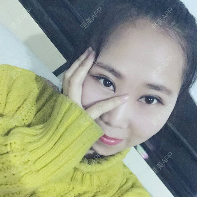 更美 - 伊伊  💕的双眼皮经验 | 双眼皮 | 开内外眼角 | 上睑下垂矫正 | 双眼皮手术