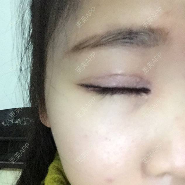 更美 - 伊伊  💕的双眼皮经验 | 双眼皮 | 开内外眼角 | 上睑下垂矫正 | 双眼皮手术