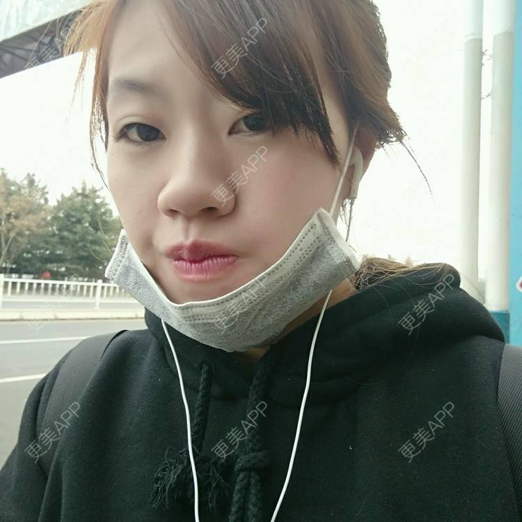 更美 - 👑匡匡的经验 | 你看我整哪 | 鼻部多项 | 下巴 | 威海