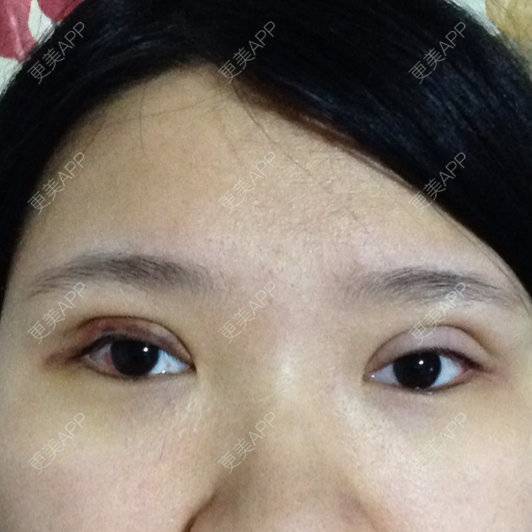 78jady的全切双眼皮日记