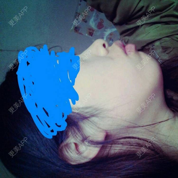 更美 - 傻虫虫的经验 | 下巴截骨前移 | 西安