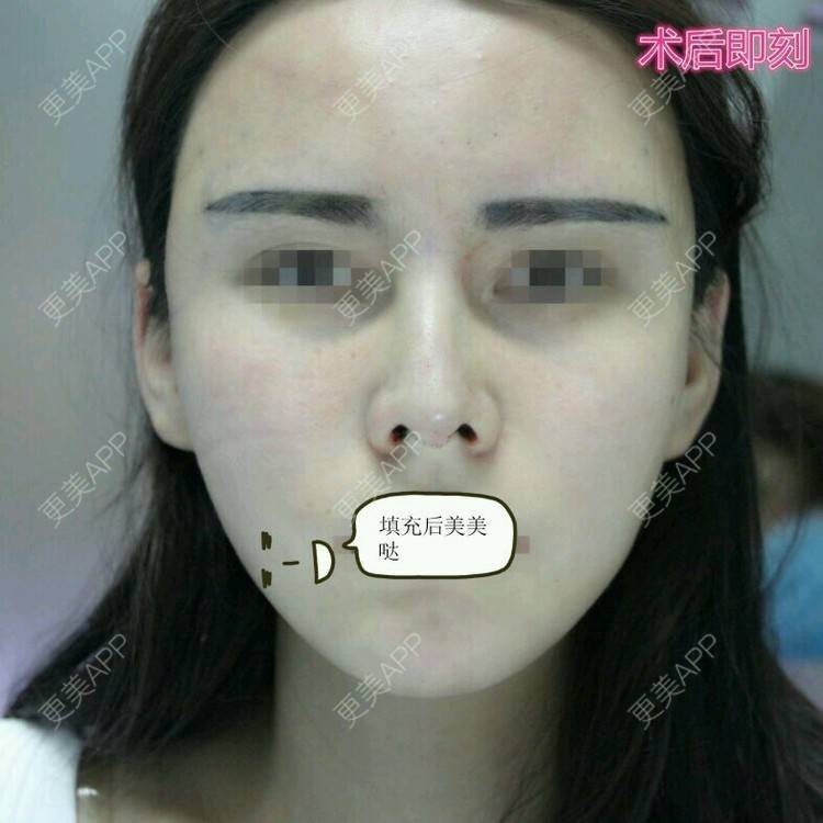 更美 - Mrs.Li👯的经验 | 郑州 | 自体脂肪填全脸 | 隆鼻修复